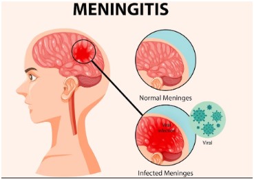 Meningitis