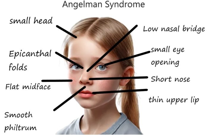 Angelman Syndrome