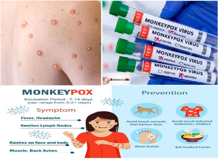 Monkeypox Sign and Symptoms