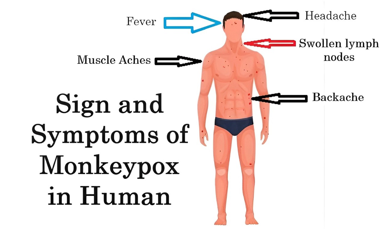 New Monkeypox Sign and Symptoms