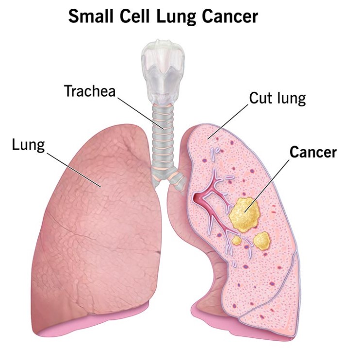 Lung Cancer